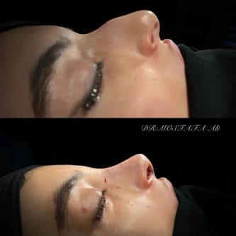 مزايا تقنية البيزو في تجميل الأنف