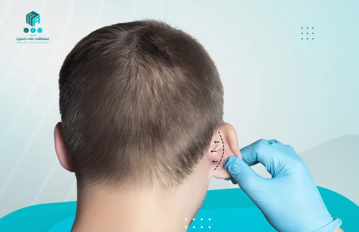 تجميل الأذن الخفاشية