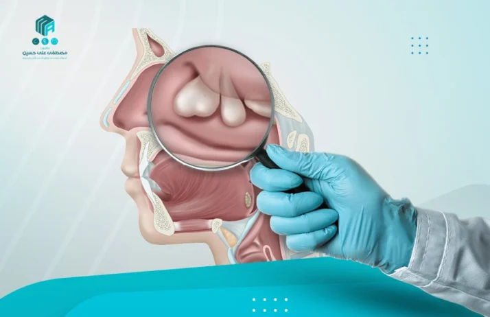 علاج لحمية الانف