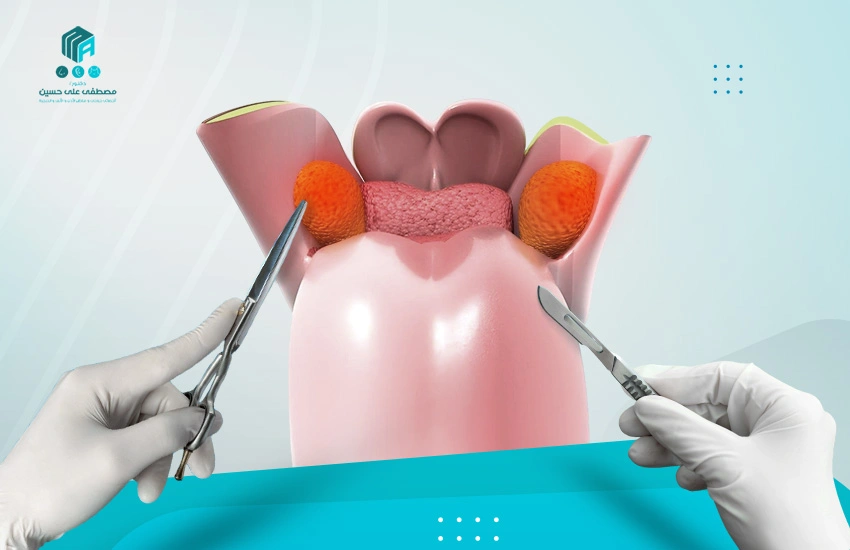 كل ما يخص عملية استئصال اللوزتين