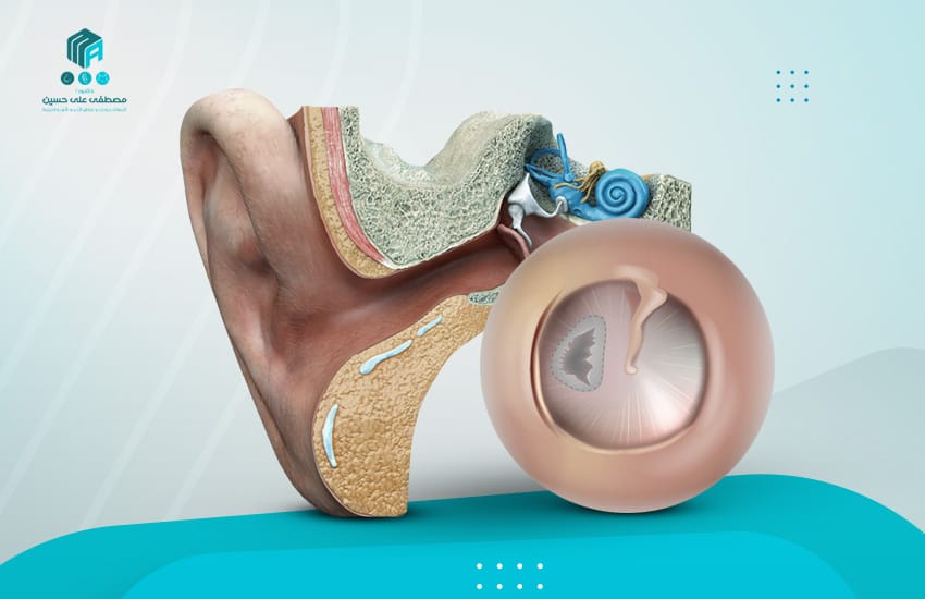 عملية ترقيع طبلة الأذن
