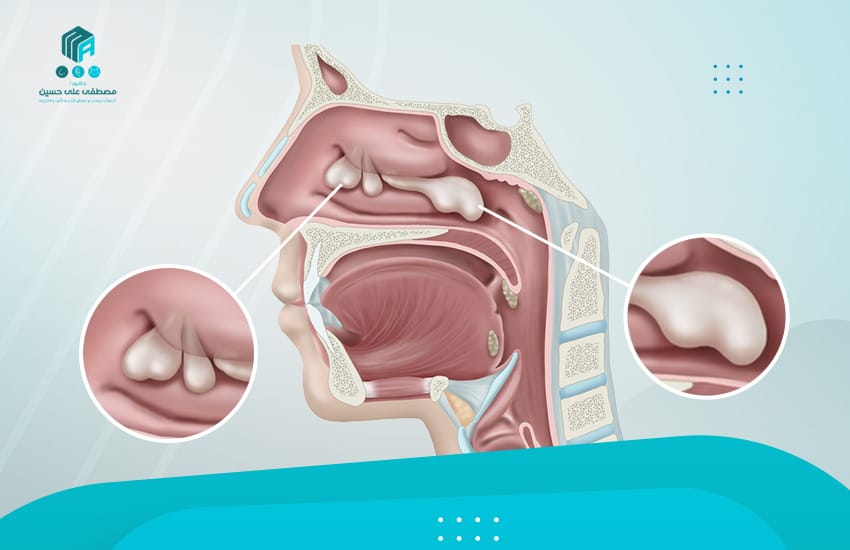 تعرف إلى أسباب وانواع لحمية الانف