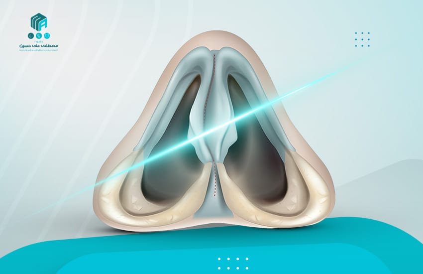 هل عملية انحراف الحاجز الانفي بالليزر حل فعال ونهائي لإصلاحه؟